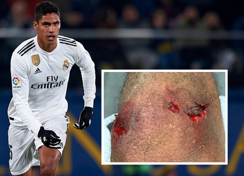 Raphael Varane pokazał zdjęcie swojej nogi po meczu z Barceloną. To musiało zaboleć