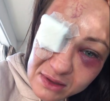 Karolina Kowalkiewicz pokazała twarz po walce. Polka może stracić wzrok [WIDEO]