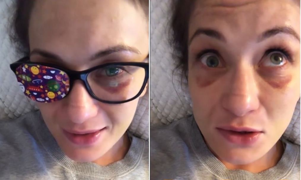 Karolina Kowalkiewicz pokazała uszkodzone oko. "Ono się nie rusza. Wierzę, że to nie koniec" [WIDEO]
