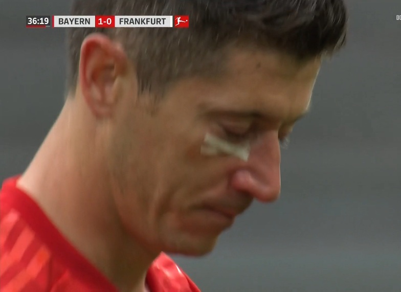 Robert Lewandowski znokautowany ciosem rodem z ringu bokserskiego. Rozcięta twarz Polaka [ZDJĘCIE]