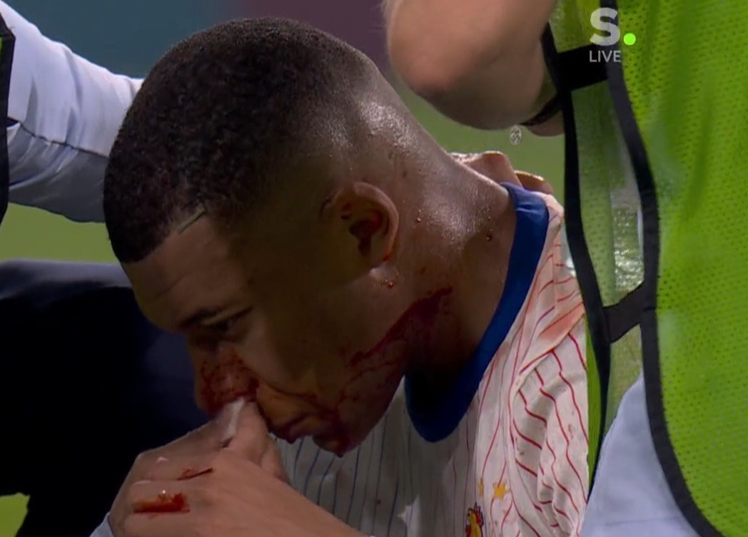 Mbappe cały we krwi! "Rzeźnia" w meczu Francji [WIDEO]
