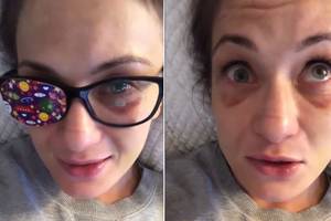 Karolina Kowalkiewicz pokazała uszkodzone oko. "Ono się nie rusza. Wierzę, że to nie koniec" [WIDEO]
